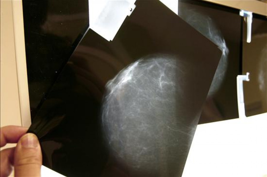 Los test genéticos de tumores de mama evitan usar quimioterapia en ciertos casos