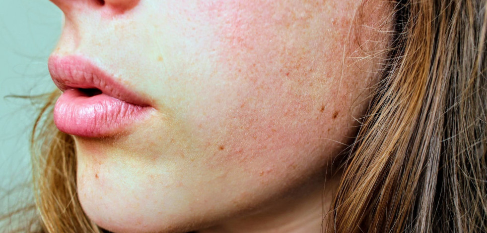 ¿Cuáles serán las mayores novedades en Dermatología en 2019?