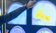 Descubren el primer contagio accidental del alzhéimer