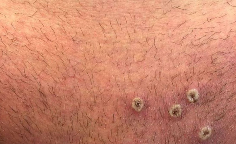 Europa sugiere vacunar a contactos de riesgo de infectados con viruela del mono