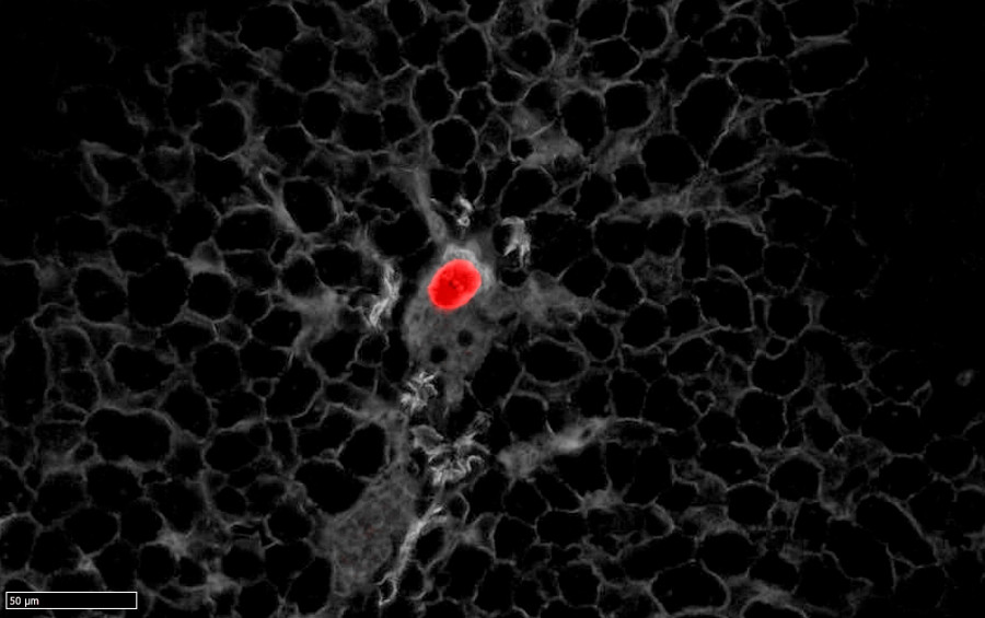 Descubiertas las células malignas que se desprenden del cáncer y provocan las muertes por metástasis