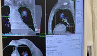 El hospital de A Coruña prueba con éxito un tratamiento de inmunoterapia para un tipo de cáncer de pulmón agresivo