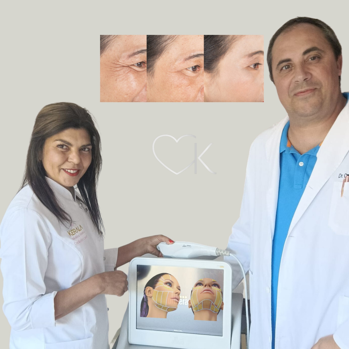 Resultado tras el tratamiento Ultherapy 