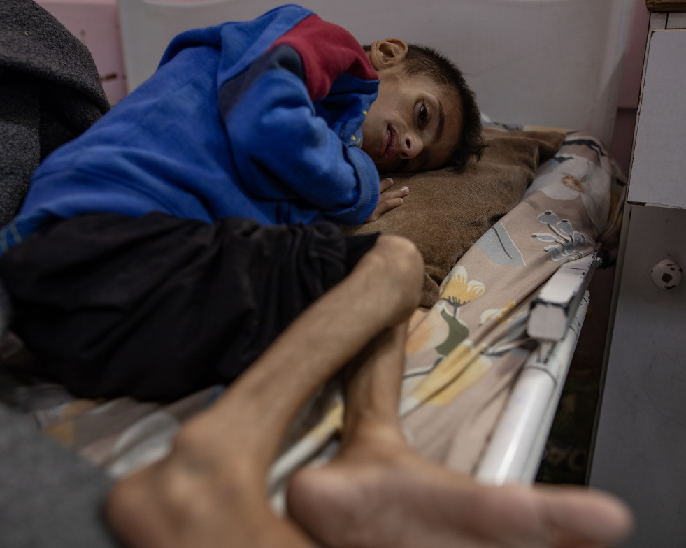 Khan Younis (---), 31/05/2025.- Five year-old Osama al-Raqab, suffering from severe malnutrition, undergoes treatment at the Nasser Hospital in Khan Youni in the southern Gaza Strip 31 May 2025. His m